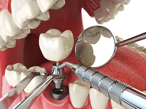 Best Knocked-Out Tooth (Avulsed Tooth) Treatment in Lowell, MA